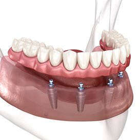 Illustration of a full denture supported by dental implants